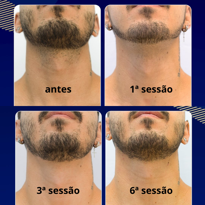 Evolução da depilação a laser ao longo das sessões